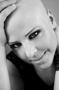 alopecia areata