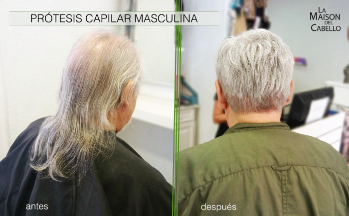 Prótesis Capilar Masculina