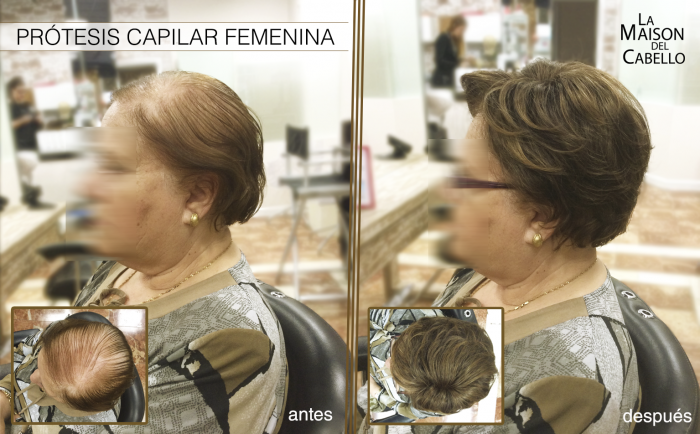 Prótesis Capilar Femenina