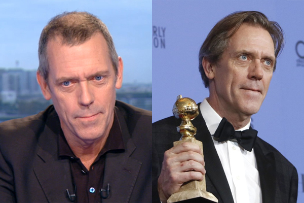 implantes capilares hollywood hugh laurie