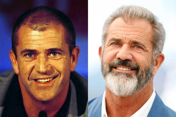 mel gibson alopecia