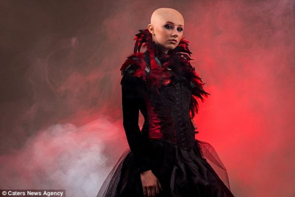 joven de 15 años con alopecia