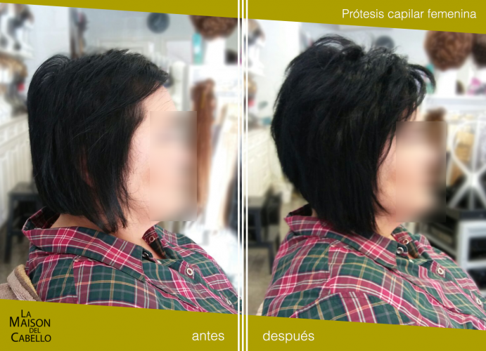 postizo capilar femenino alopecia