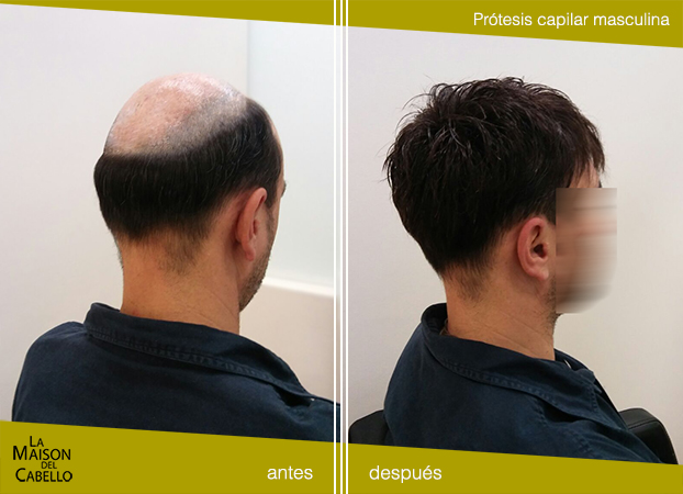 alopecia hombre