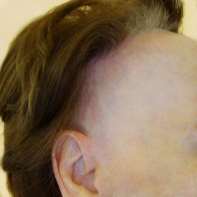 frontal fibrosing alopecia