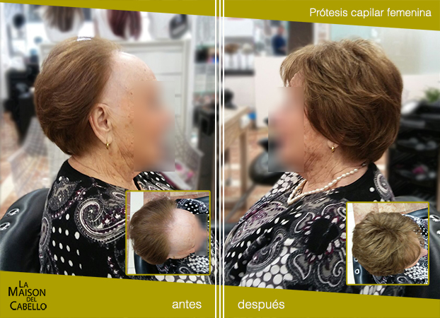 alopecia frontal fibrosante