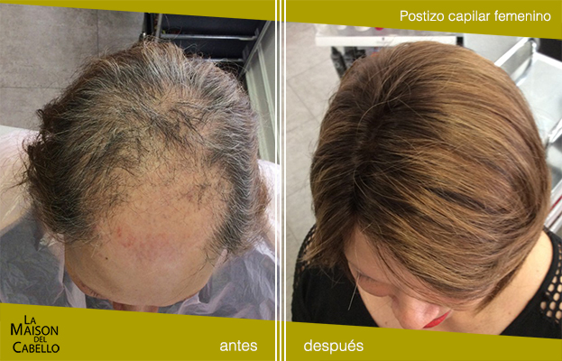 prótesis capilares para mujeres con alopecia