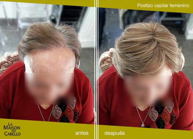 prótesis capilar alopecia frontal fibrosante