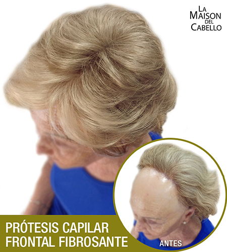 Alopecia Frontal Fibrosante La Maison del Cabello