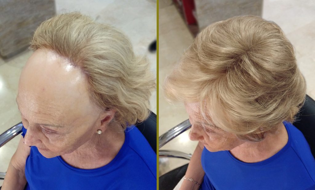 alopecia frontal fibrosante antes y despues la maison del cabello