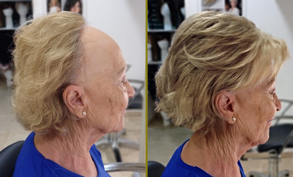 alopecia frontal fibrosante antes y despues la maison del cabello