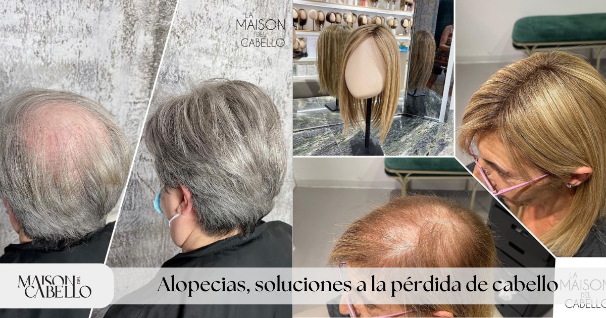 Alopecias, soluciones a la pérdida de cabello - Blog LMC